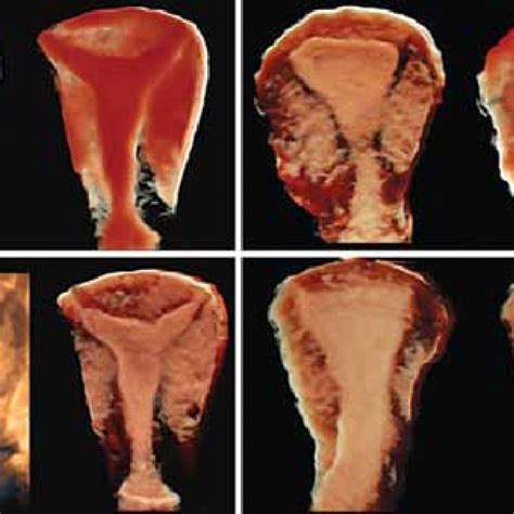 Limits between myometrium and endometrium 'shell mode' of a normal... | Download Scientific Diagram