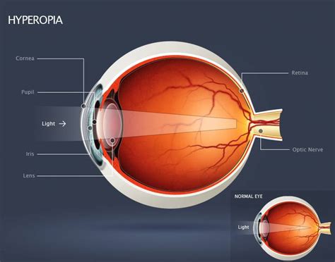 Hyperopia