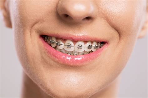 ¿Cuáles son los beneficios de la ortodoncia? - Clínica Dental Gramadent