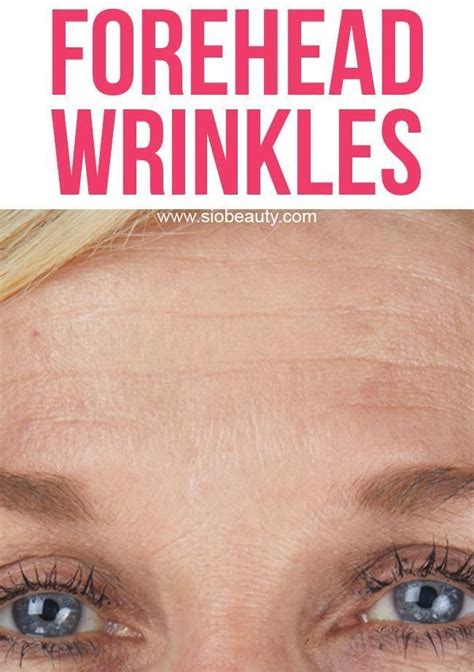 `Here's how you get rid of forehead wrinkles, also known as brow furrows. Reduce expression ...