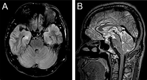 MRI scans of HE patients. ( A and B ) Patient No.4 with memory... | Download Scientific Diagram