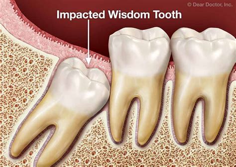 Wisdom Tooth Extraction | Joseph Hudgins Orthodontics | Carbondale Illinois
