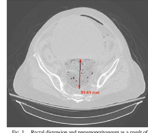 Figure 1 from Rectal Stercoral Ulcer Perforation | Semantic Scholar