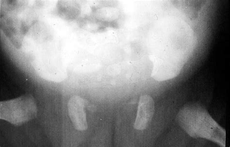 Spondyloepiphyseal dysplasia congenita - wikidoc