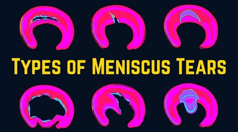 6 Meniscus Tear Types That You Need To Know About