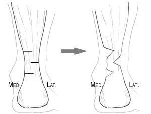 Pin on Heel Cord Info.