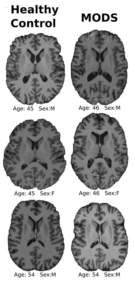 MODS patients with no apparent brain damage (NABD). Even for a ...