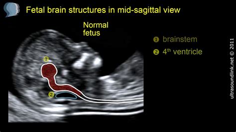 Open spina bifida at 11-13 weeks' gestation: brainstem - YouTube