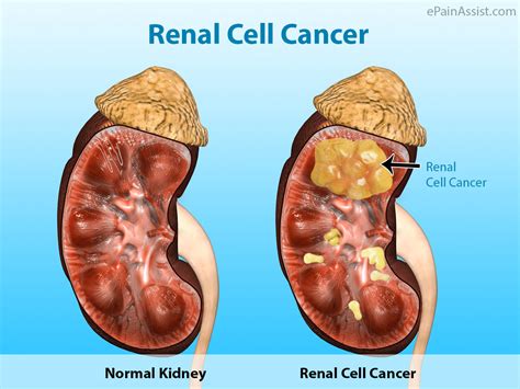 Renal Cell Cancer: Treatment, Complications, Prognosis