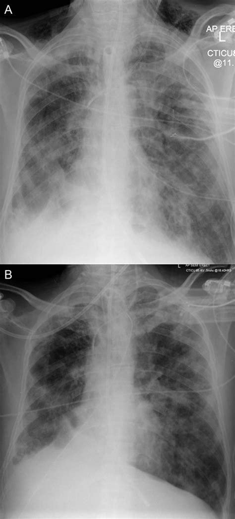 Imaging of Acute Respiratory Distress Syndrome | Respiratory Care