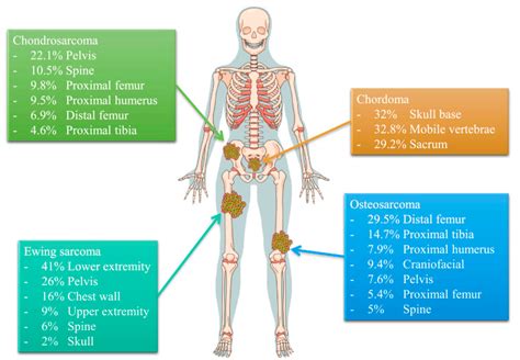 Strontium For Bone Cancer Patients