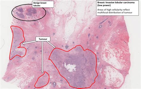 Breast – Carcinoma With Lymph Node Metastases – NUS Pathweb :: NUS Pathweb