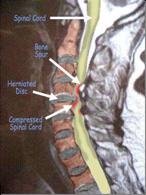 Explaining Spinal Disorders: Cervical Myelopathy