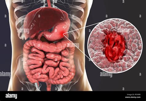 Stomach Gastric Ulcer