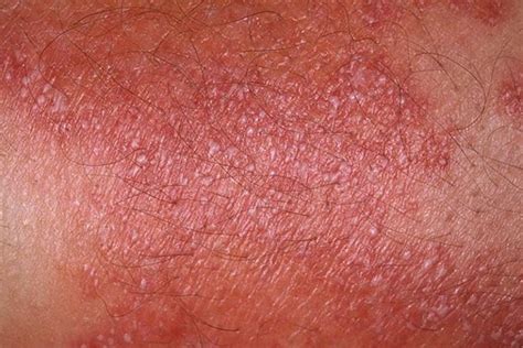 Pustular psoriasis symptoms pictures | Symptoms and pictures