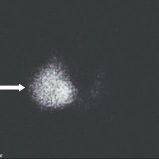 Transverse sonogram showing a large heterogeneous right thyroid nodule ...