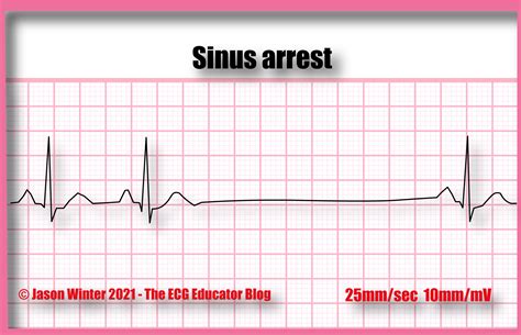 ECG Educator Blog : Sinus Arrest