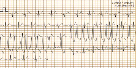 A MAN WITH RECURRENT PRESYNCOPE CONDITIONS – Mezinárodní centrum pro telemedicínu