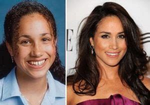 Meghan Markle Before and After Plastic Surgery