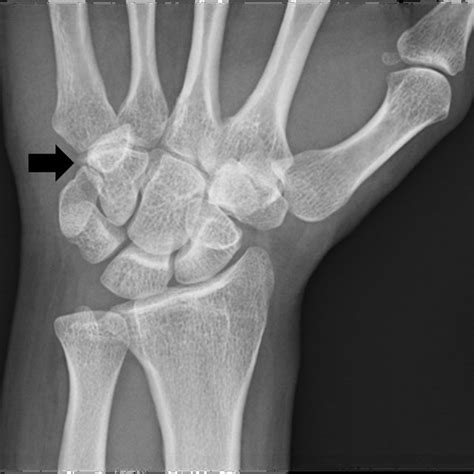 MRI finding: at 2 cm above the medial epicondyle, the ulnar nerve was ...