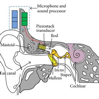 Schematic of the proposed middle ear implant. | Download Scientific Diagram