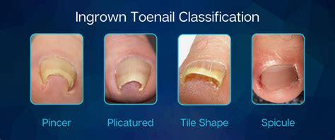 Ingrown Toenails – Bespoke Health - An Tâm