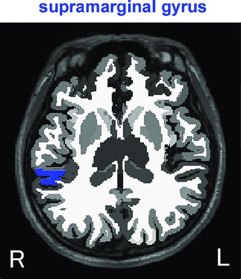 Location of the right supramarginal gyrus in axial view (blue area). | Download Scientific Diagram