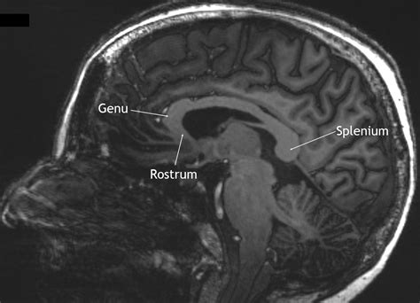 Corpus callosum - Ars Neurochirurgica