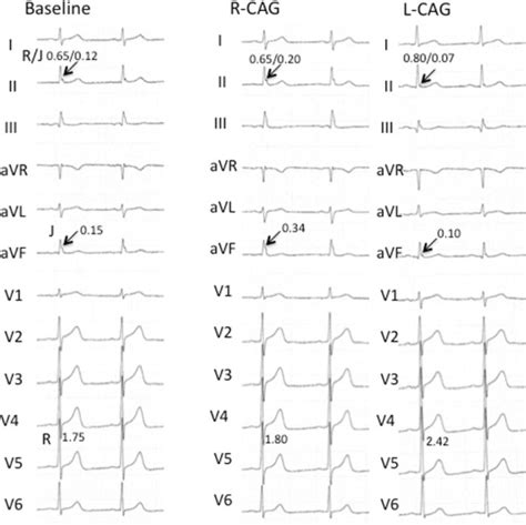 Incidence and Implications of J waves Observed During Coronary Angiography - American Journal of ...