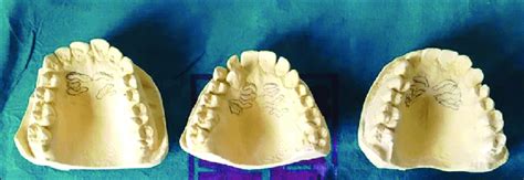 Palatal rugae patterns | Download Scientific Diagram