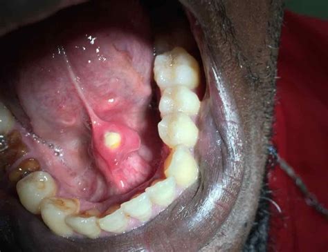 Image of the Week: A Hard Lesion Near the Frenulum of the Tongue ...