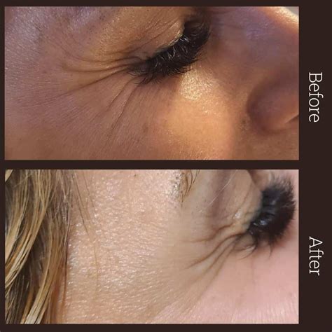 Before & After Botox | Dermatouch | Richmond Hill Botox Clinic