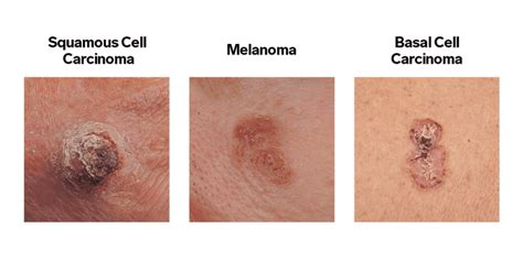 Melanoma Skin Cancer Stages