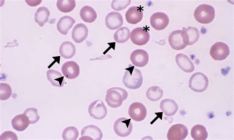 Hypochromasia – Cells and Smears