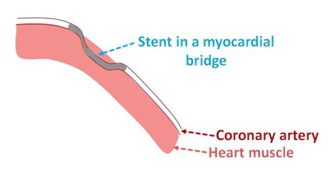 What is a myocardial bridge? – All About Heart And Blood Vessels