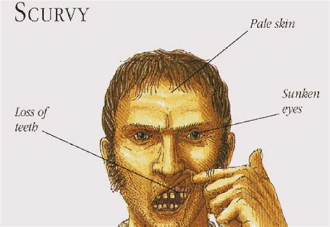 Scurvy: Vitamin C Deficiency, Symptoms & Treatment