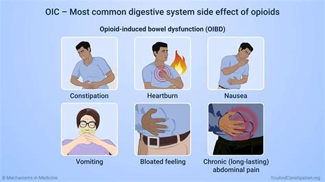 OIC – Most common digestive system side effect of opioids OIC is the most common side effect ...