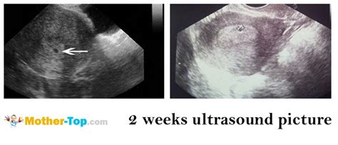 2 weeks pregnant ultrasound pictures