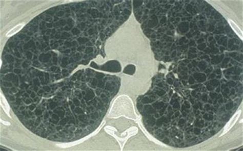 URMC Opens Clinic, Initiates Research on Rare Lung Disease in Women ...