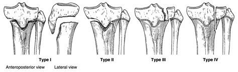 Proximal Tibia Fracture Classification