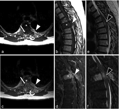 Figure 1 from Aggressive hemangioma of the thoracic spine. | Semantic Scholar