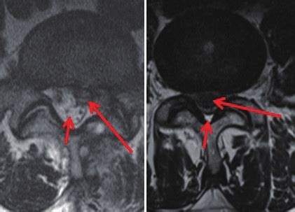 Spinal Cord Mri Axial