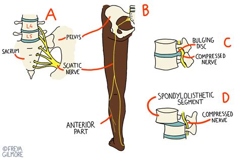 Sciatica