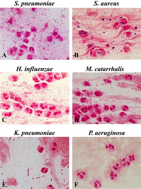 Bacterial morphotypes in sputum Gram stain (×100, oil immersion field).... | Download Scientific ...