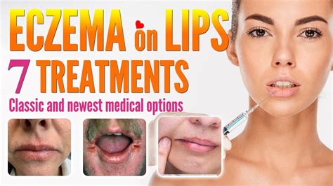 Eczema on Lips Treatment Options | How to Treat Lip Eczema Around Mouth Dermatitis - Overseas Doctor