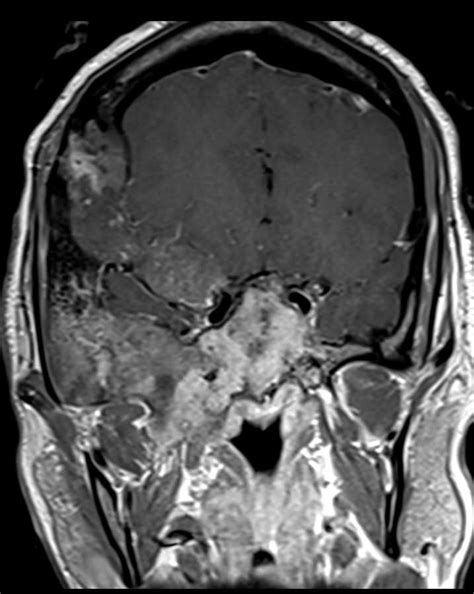 Fibrous Dysplasia Mri