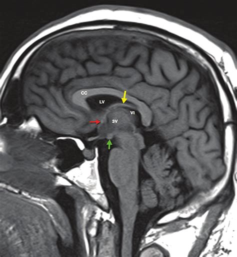 Septum Pellucidum And Fornix