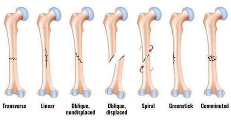 #Fractures - MEDizzy