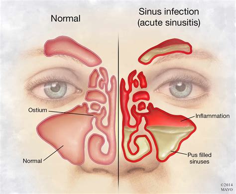 Sinus Canal Infection