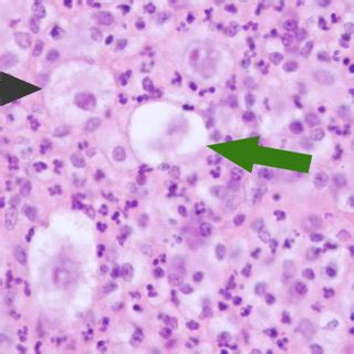 Histology from sternal aspirate. Illustrates mixed inflammatory cells ...